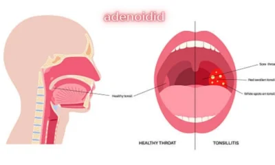 adenoidid