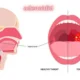 adenoidid