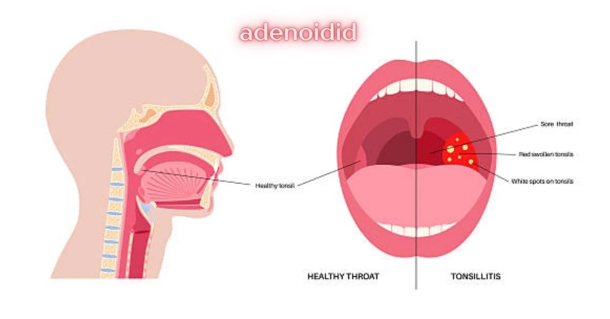 adenoidid